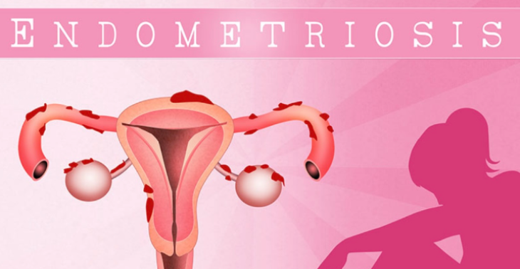 Fysiotherapie endometriose