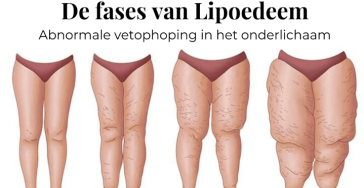 Liposucties lipodeem