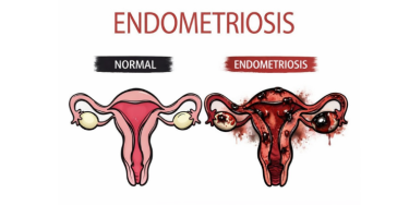 Endometriose is geen bijzaak