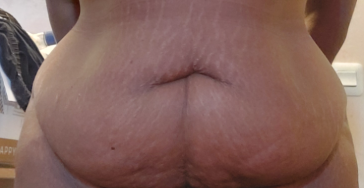 Buikwandcorrectie
