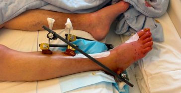 Van hartinfarcten tot dialyse, een zware strijd op overleven