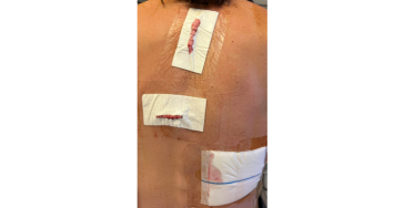 Neurostimulator voor chronische neuropathische pijn
